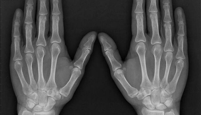 artritisa eta artrosia diagnostikatzeko erradiografia