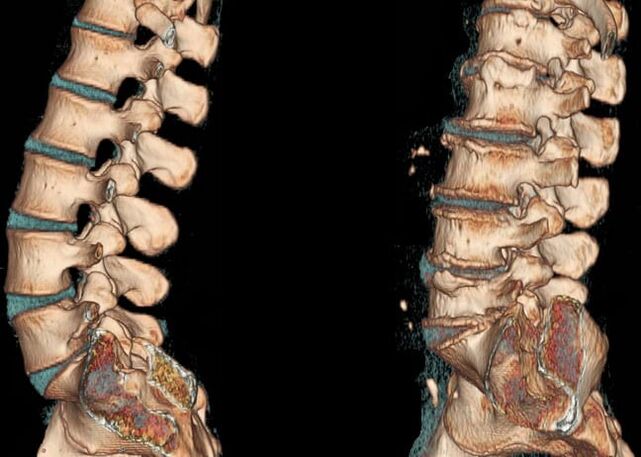 Lumbar eskualdeko osteokondrosia