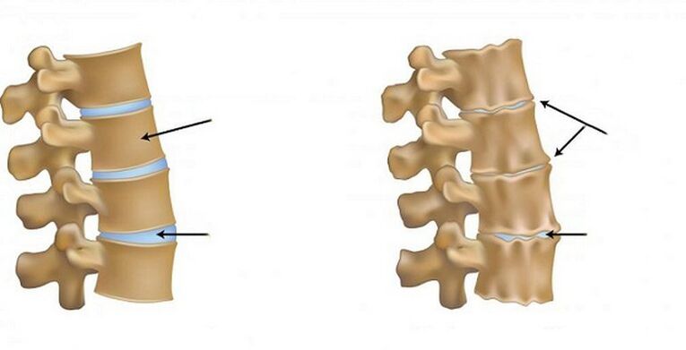 Osteokondrosiaren sindrome iskemikoa
