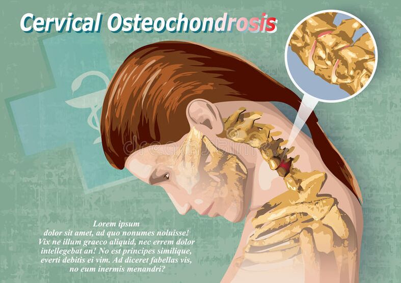 Osteokondrosia cervikala kartilago ehunen gaixotasuna da