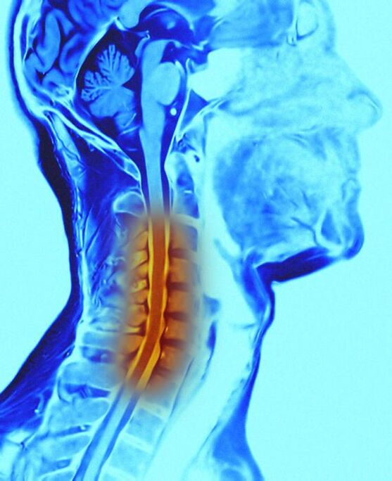 zerbikal bizkarrezurra eta osteokondrosia